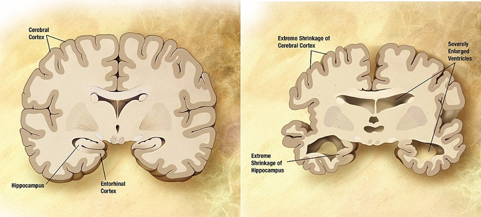 Alzheimer disease effect on brain structure.