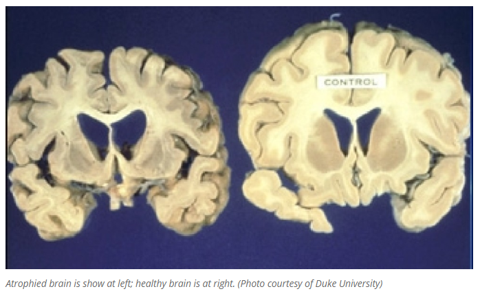 Mad Cow disease effect on brain structure.